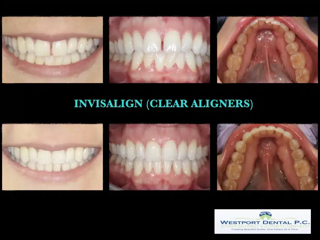 INVISALIGN.001.jpg