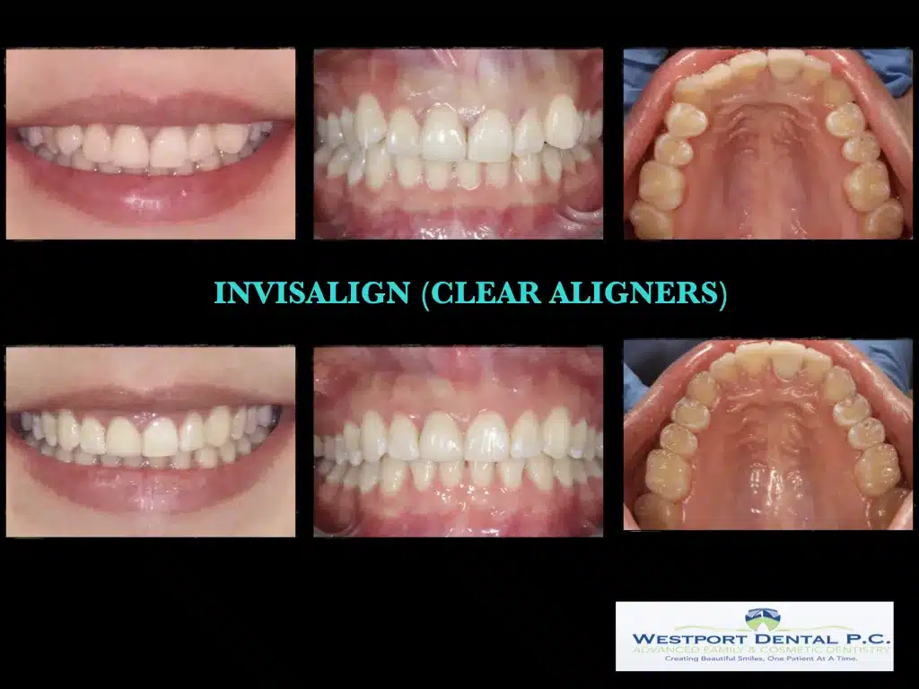 INVISALIGN.002.jpg