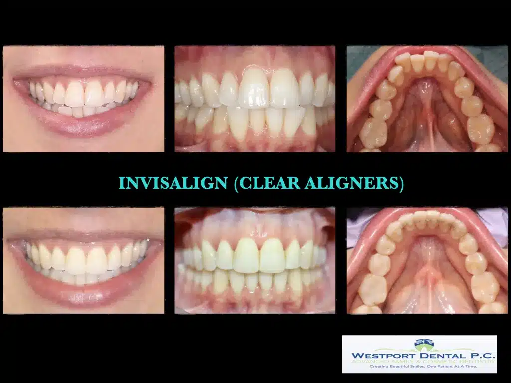 INVISALIGN.003.jpg