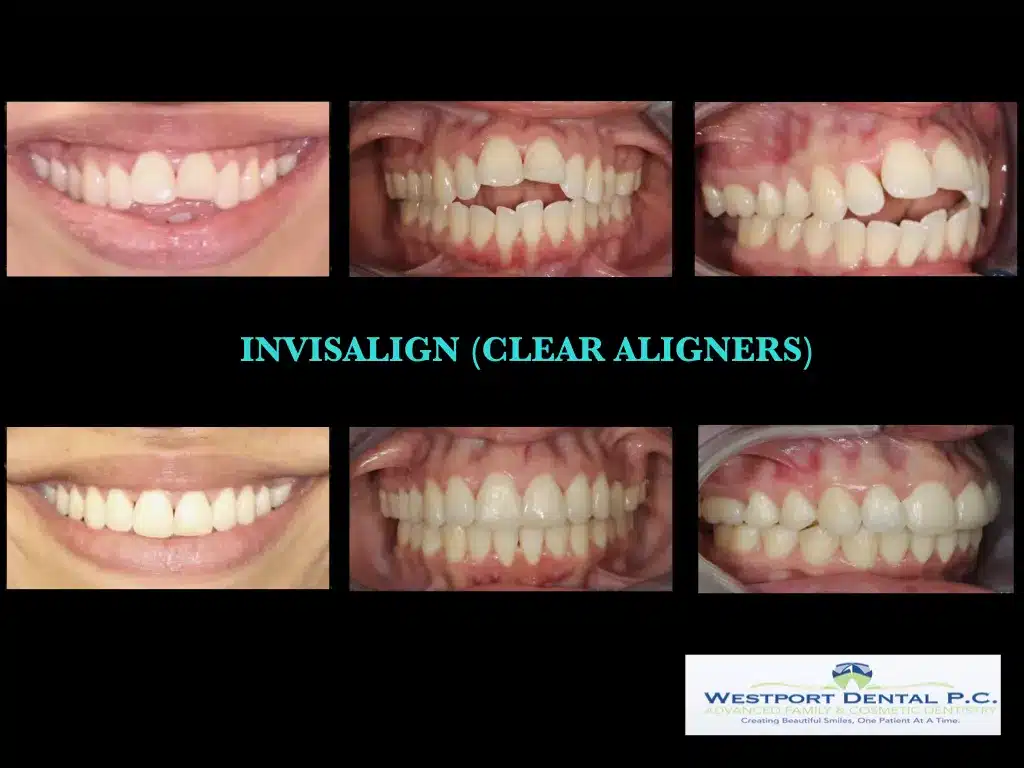 INVISALIGN.004.jpg
