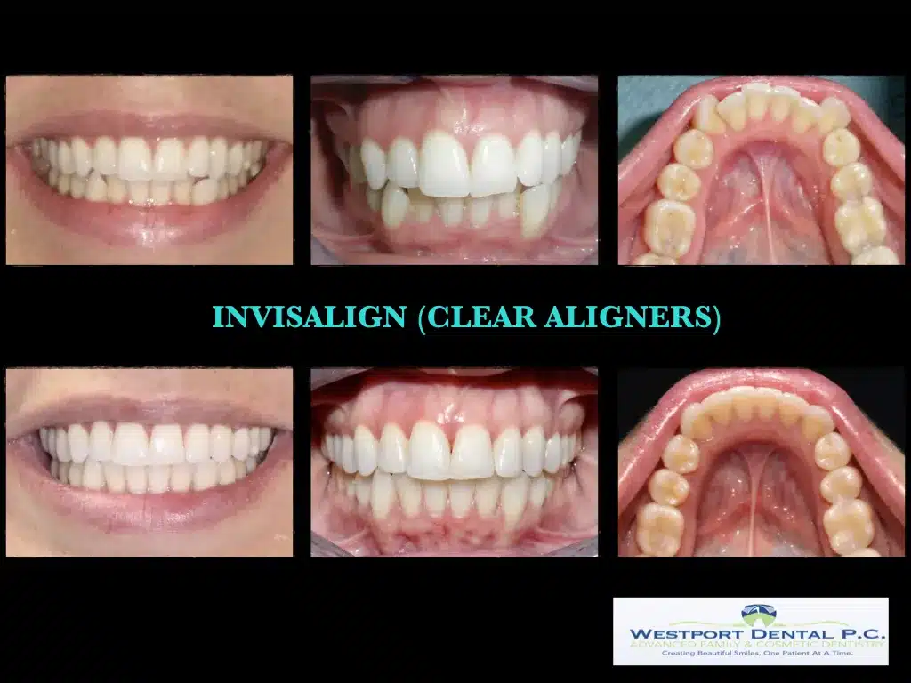 INVISALIGN.005.jpg