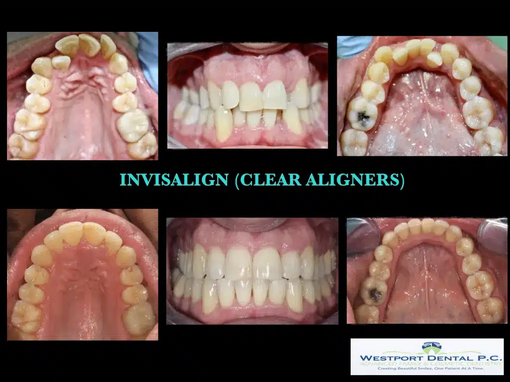 INVISALIGN.006.jpg